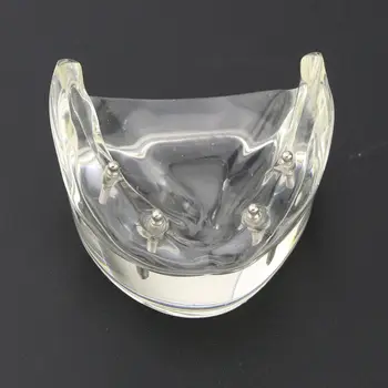 1Pc Dantų Dantų Studijų Modelį Overdenture Prastesnės 4 Implantas Demo Modelis 6002 02
