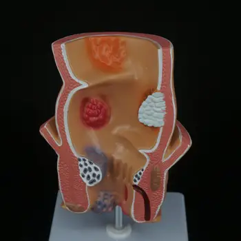 Anatominiai Žmogaus Tiesiosios Žarnos Patologija Pralaimėjimai Modelis Hemorojus, Išangės Medicinos Mokymo Tiesiosios Žarnos Mokymosi