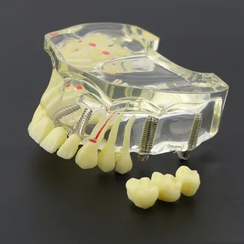 Dantų Implantą Viršutiniame Žandikaulyje Modelis Su Tiltas & Ėduonies Dantų Studijų Mokyti Dantų Modelis