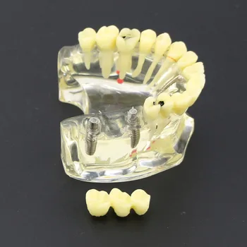 Dantų Implantą Viršutiniame Žandikaulyje Modelis Su Tiltas & Ėduonies Dantų Studijų Mokyti Dantų Modelis