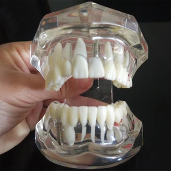 Dantų Tyrimas, Dantų Skaidrus Suaugusiųjų Patologinį Dantų Modelį Suaugusiųjų Mokymo Studijų