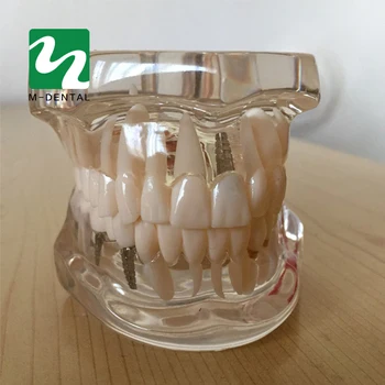 Dantų Tyrimas, Dantų Skaidrus Suaugusiųjų Patologinį Dantų Modelį Suaugusiųjų Mokymo Studijų