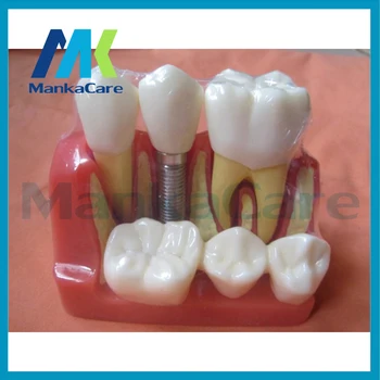 Manka Priežiūra - Dantų dantų modelio dantų sodinimo dantų modelio skilimo danties modelis sprogo išimami dantų mokymo modelį